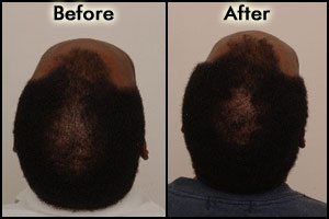 Images for Procerin Before and After