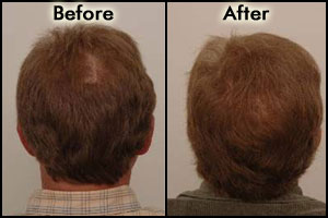 Images for Procerin Before and After