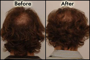 Images for Procerin Before and After