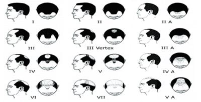 Norwood-Hamilton Scale of Male Pattern Baldness