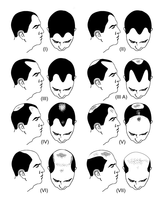 Norwood Scale of Male Pattern Baldness