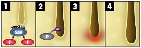 Procerin Effects on DHT